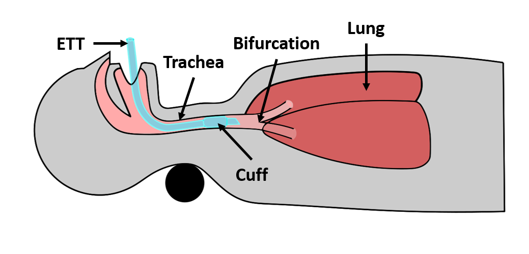 IntubatedPatient